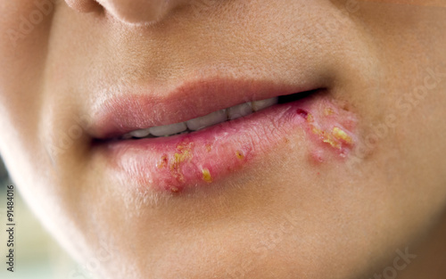 lips affected by herpes photo