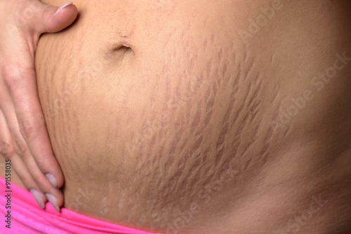 Woman displaying stretch marks after pregnancy photo