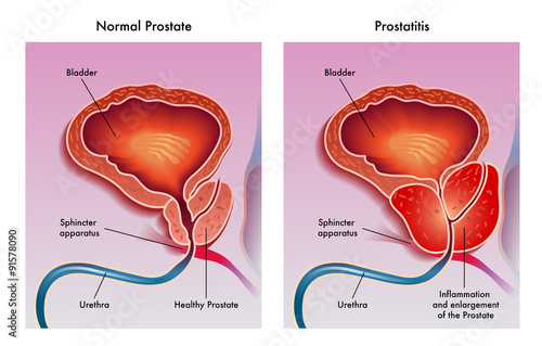Prostatite