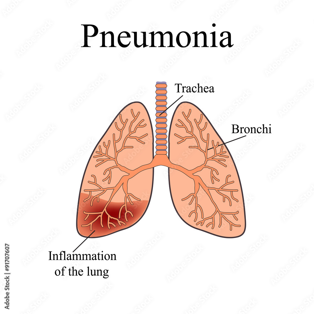Pneumonia. The anatomical structure of the human lung. Vector Pneumonia. The anatomical structure of the human lung. Vector