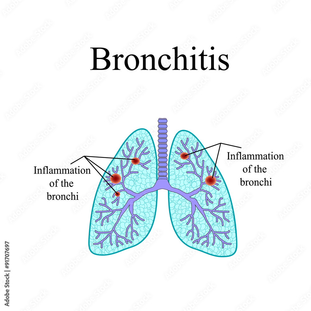 Bronchitis. The anatomical structure of the human lung. Vector