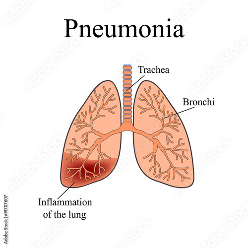 Pneumonia. The anatomical structure of the human lung. Vector