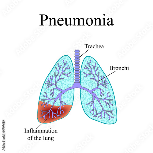 Pneumonia. The anatomical structure of the human lung. Vector