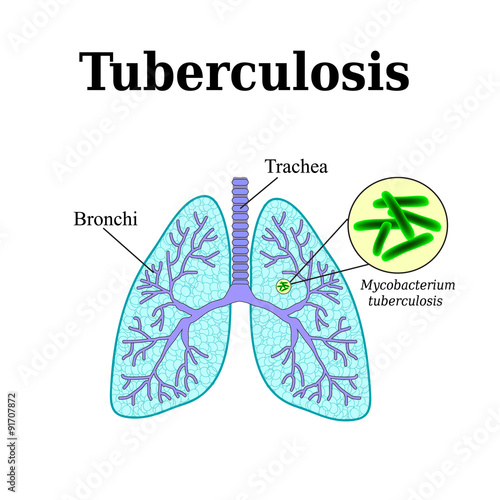 Tuberculosis. Lung disease. Tubercle bacillus. Vector