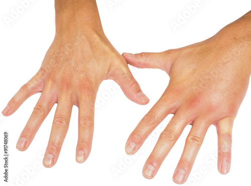 Wallpaper Mural Comparing swollen male hands isolated towards white background