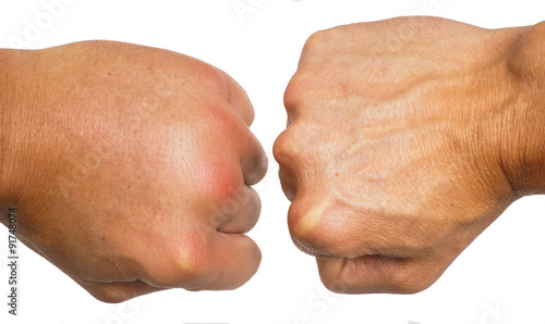 Fotografie, Obraz Comparing swollen male hands isolated towards white background