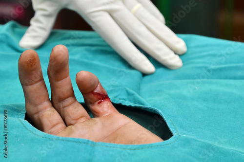 Billede på lærred incision wound will suture with sterile technique.