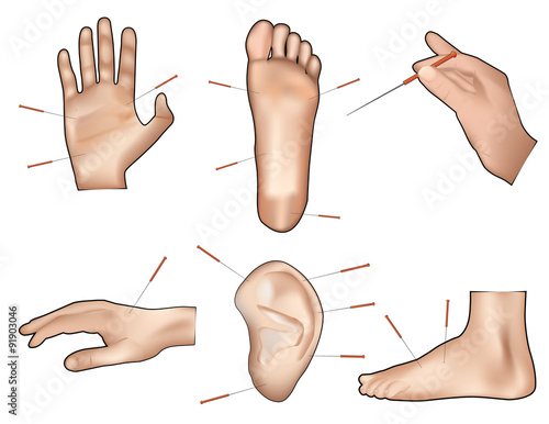Acupuntcture vector illustration
