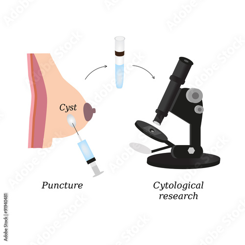Puncture of cysts in the breast. Cytological analysis. Biopsy