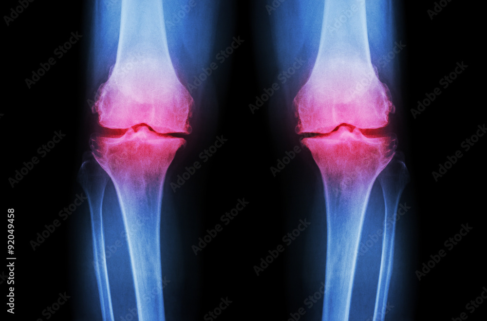 Osteoarthritis Knee ( OA Knee ). Film xray both knee ( front view ) show narrow joint space