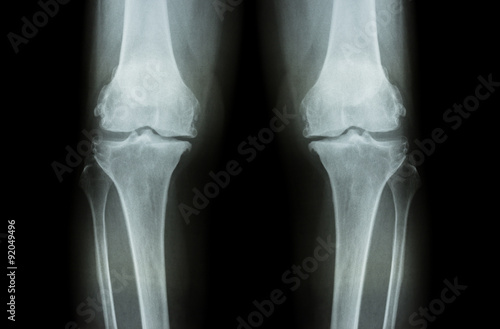 Osteoarthritis Knee ( OA Knee ). Film x-ray both knee ( front view ) show narrow joint space ( joint cartilage loss ) , osteophyte , subchondral sclerosis photo