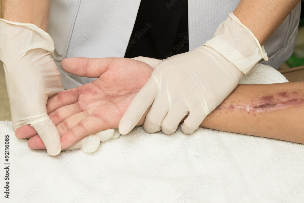 Physical therapist doing hand exercise after injury hand Physical therapist doing hand exercise after injury hand