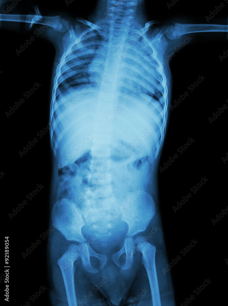 Film X-ray whole body of child ( Medical , Science and Healthcare concept ) Film X-ray whole body of child ( Medical , Science and Healthcare concept )