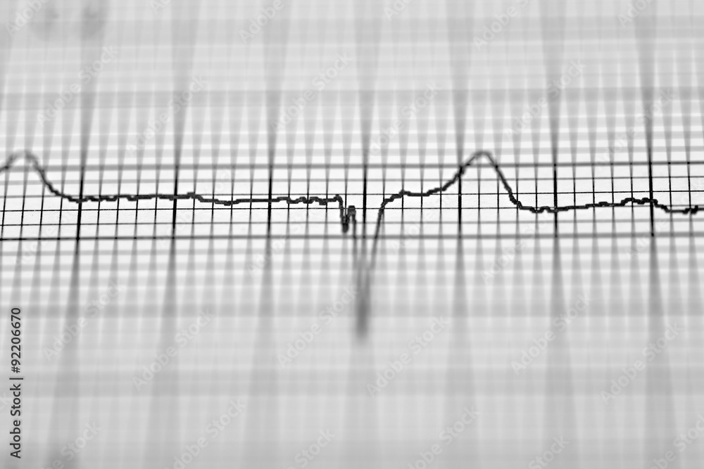 Electrocardiogram