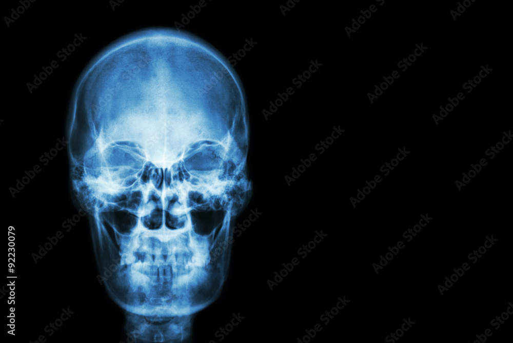film x-ray skull of human and blank area at right side ( Medical , Science and Healthcare concept and background ) film x-ray skull of human and blank area at right side ( Medical , Science and Healthcare concept and background )