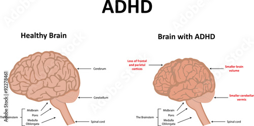 ADHD photo