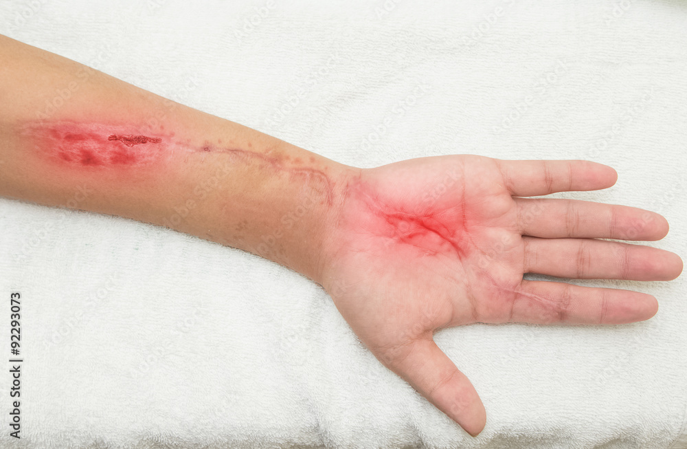 inflammation wound in the forearm inflammation wound in the forearm