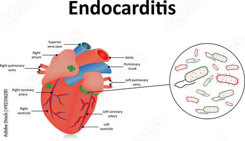 Endocarditis Illustration