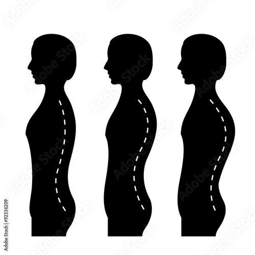 Сurvature of spine