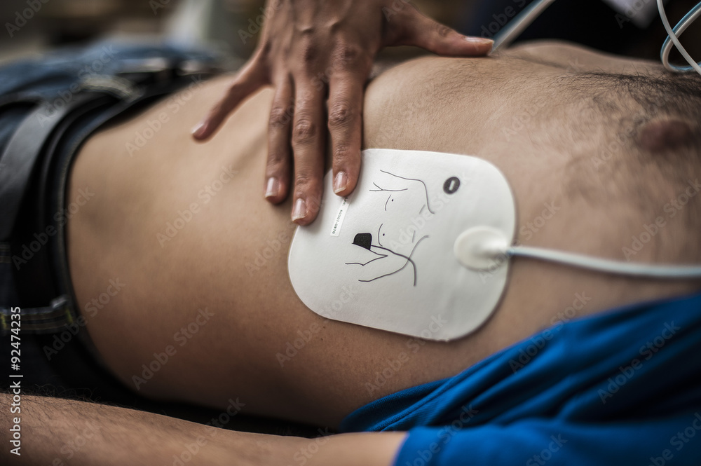Elettrodi defibrillazione - obrazy, fototapety, plakaty 