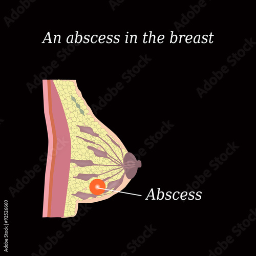 An abscess in the chest.  The structure of the breast. Mammary