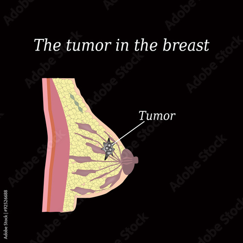 The tumor in the breast.  The structure of the breast. Mammary