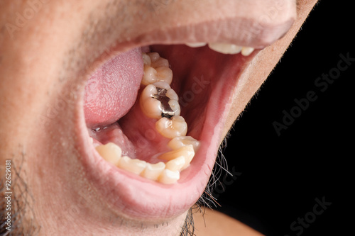 tooth filling photo