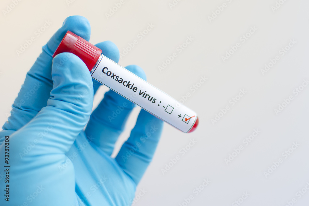 Obraz premium Blood sample with Coxsackie virus positive