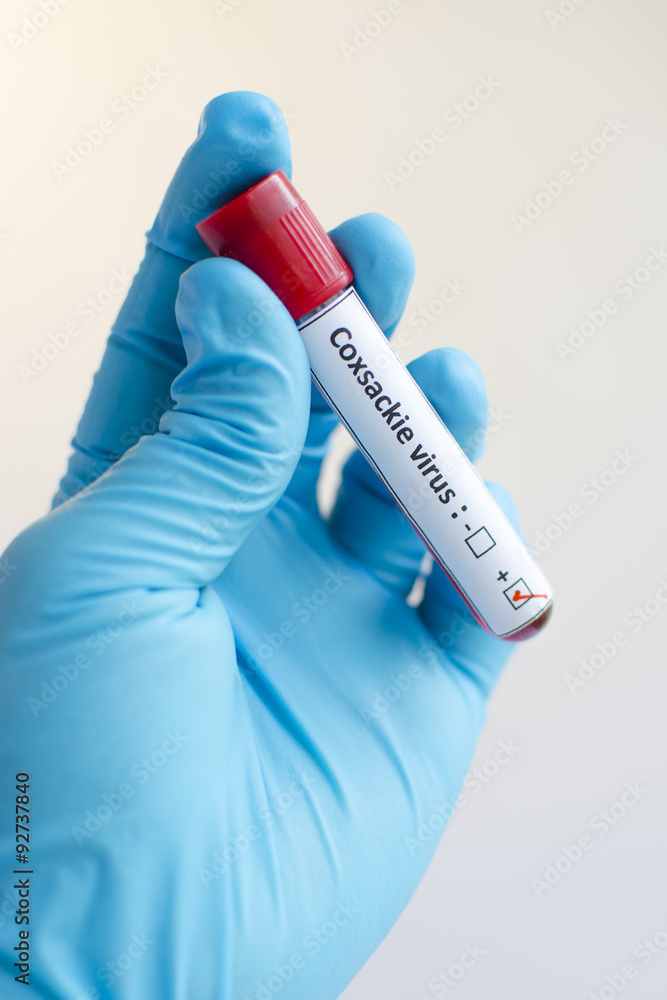 Naklejka premium Blood sample with Coxsackie virus positive