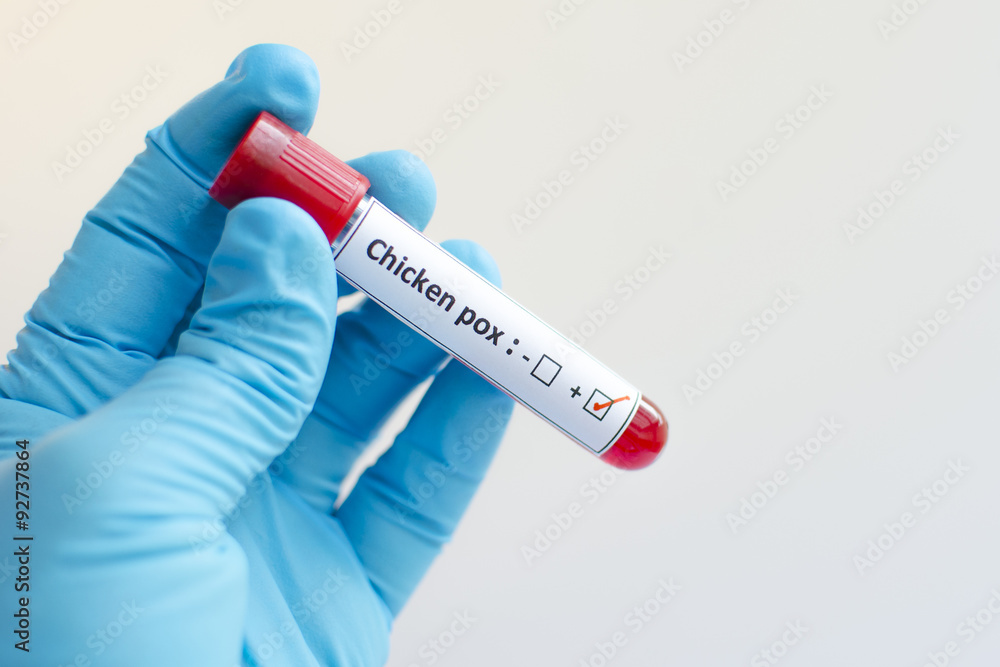 Obraz premium Blood sample with chickenpox positive