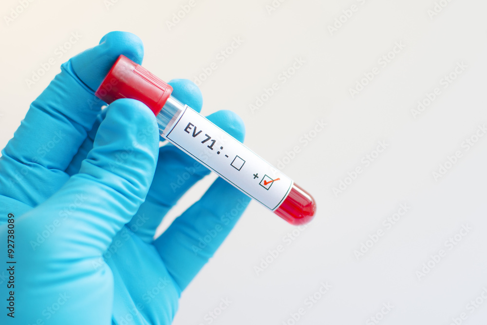 Obraz premium Enterovirus 71 (EV 71) positive
