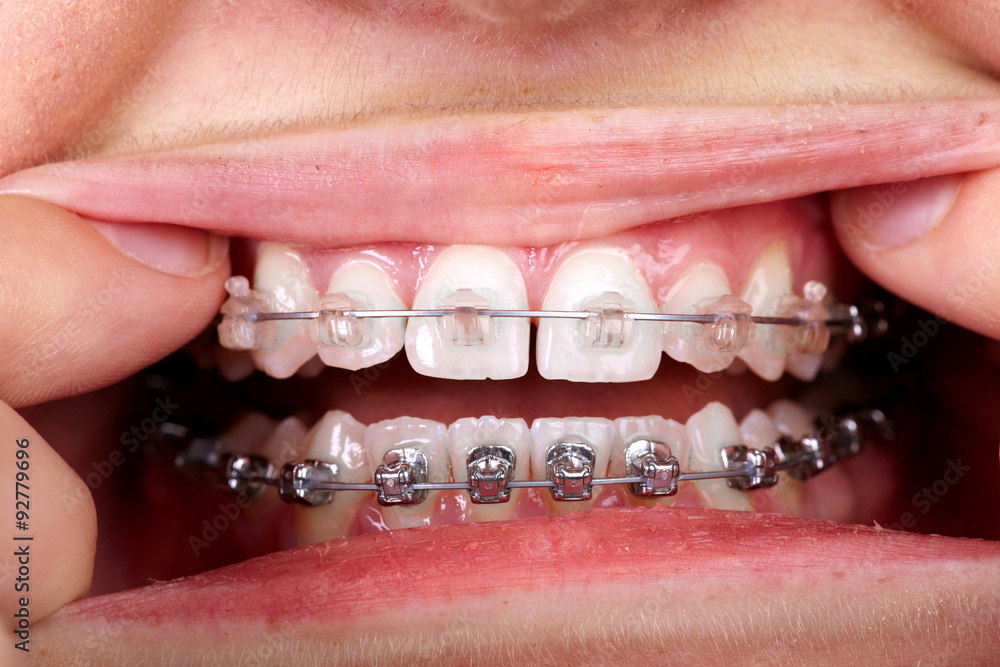 Naklejka premium Teeth with orthodontic brackets.