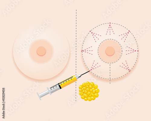 豊胸 脂肪注入 Breast Fatgrant Surgery with frontview