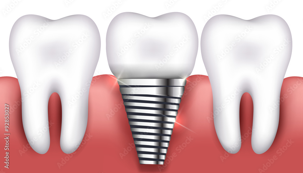 Dental implant and normal tooth Dental implant and normal tooth