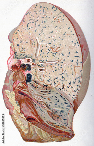 Lung, croupous pneumonia, vintage engraving. photo