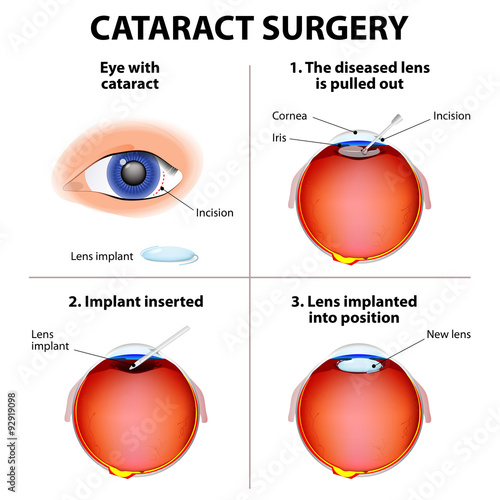 Cataract Surgery