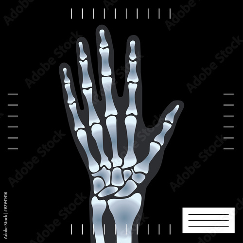 x-ray hand