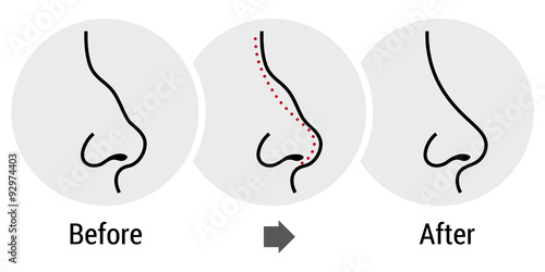 rhinoplasty