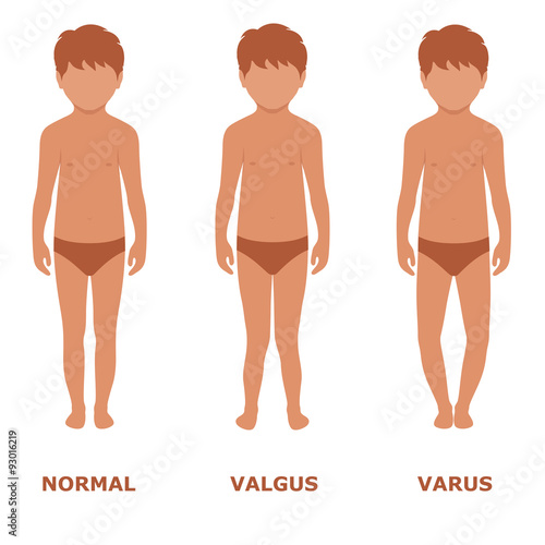 valgus, varus knee, legs disease, foot illustration