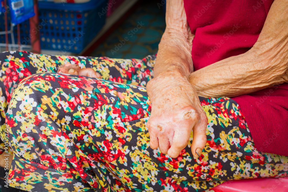 closeup hands of old woman suffering from leprosy, amputated hand, side view closeup hands of old woman suffering from leprosy, amputated hand, side view