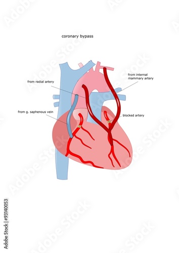 esempio di bypass cardiaco