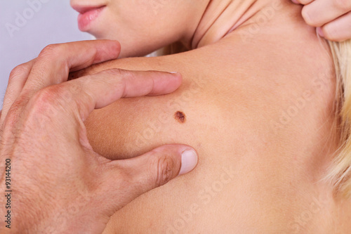 Doctor, dermatologist, hands examines a birthmark of patient. Checking benign moles photo