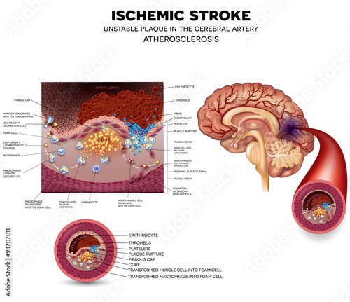 Unstable plaque formation and thrombus