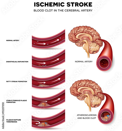 Blood clot formation in the cerebral artery photo