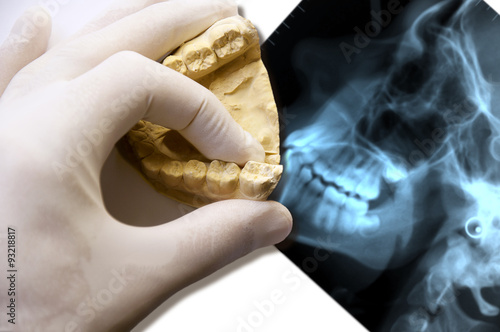modello in gesso su radiografia