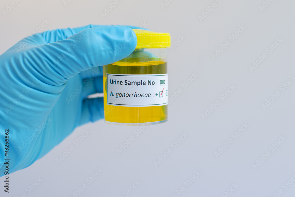 Gonorrhea Urine