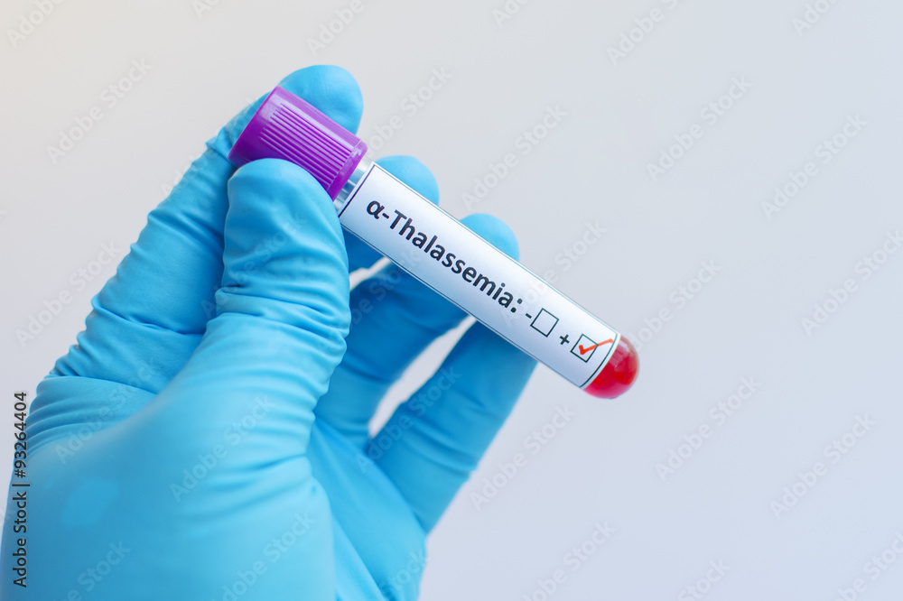 Fototapeta premium Alpha thalassemia blood sample