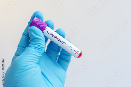Chlamydia trachomatis blood sample photo