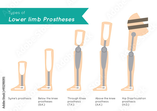 Types of Lower Limb Prosthetics infographic vector