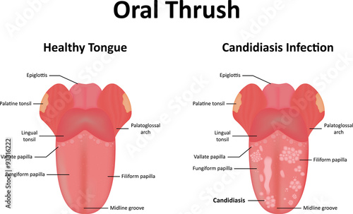 Oral Thrush